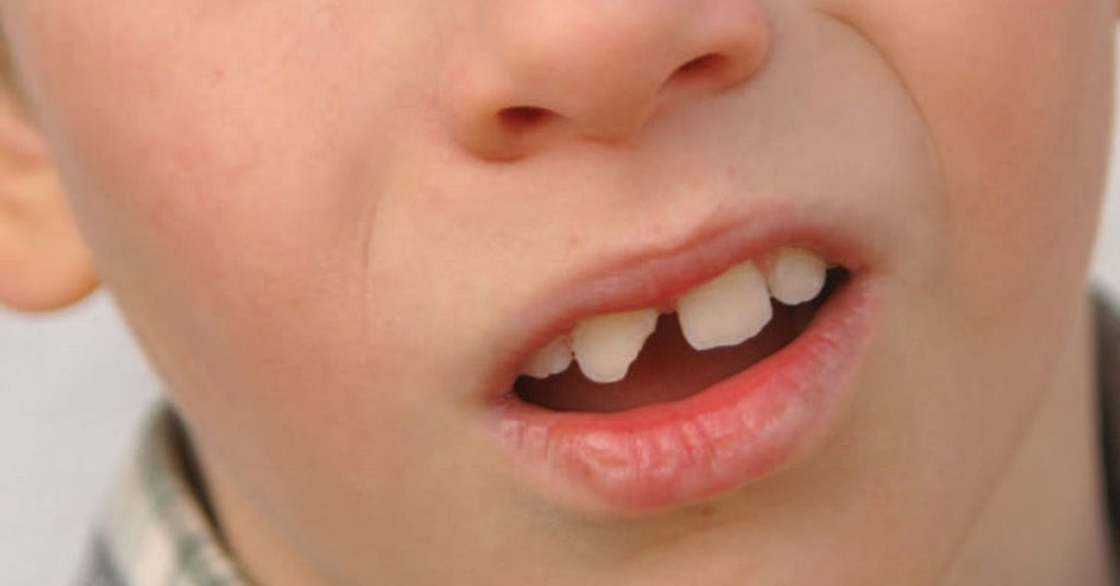 Understanding Common Dental and Facial Trauma