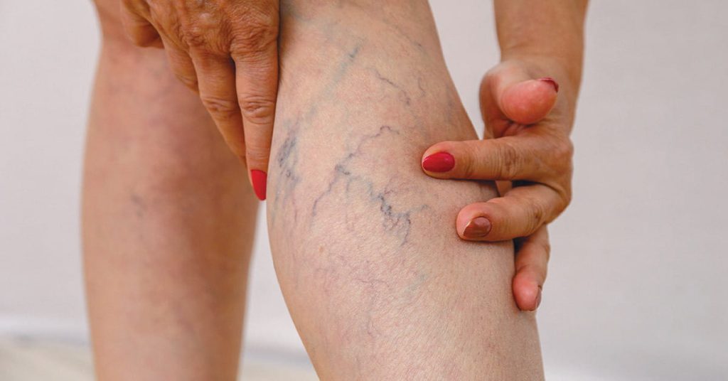 Prevent The Worsening of Your Varicose Veins With These 7 Tips